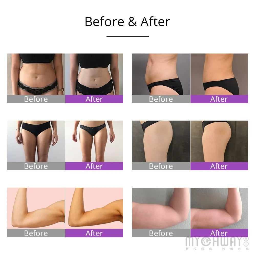 6-in-1 Multifunction Ultrasonic Cavitation Machine 2.0 | RF + Radiofrequency + Lipolaser | Fat and Cellulite Reduction